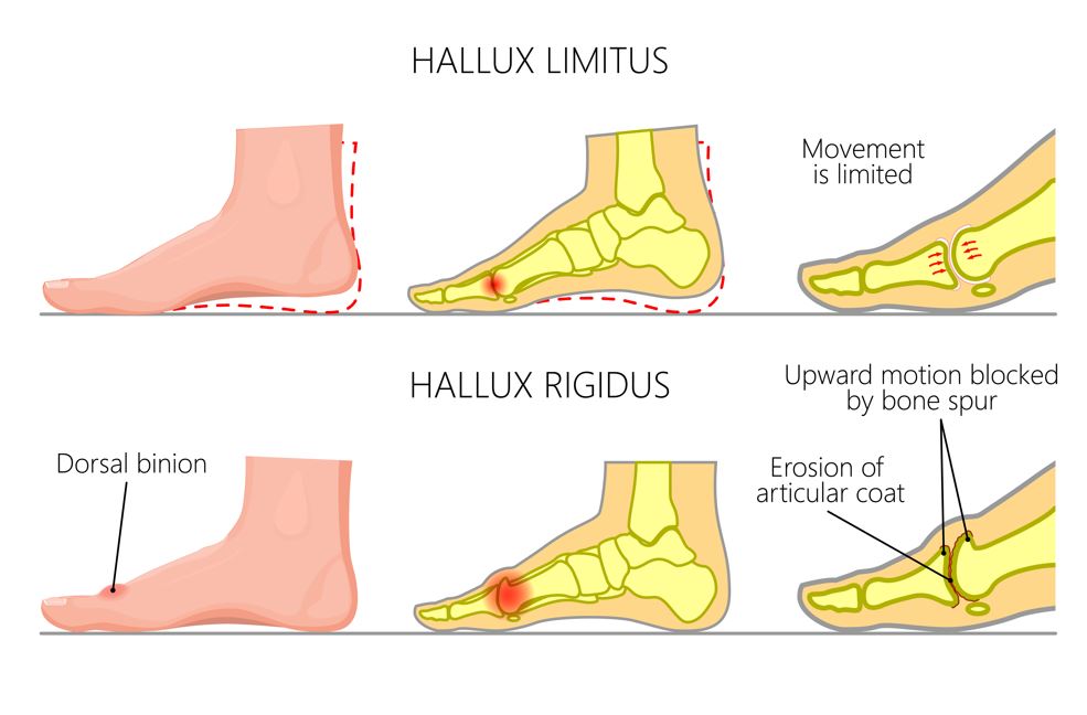What is hallux rigidus? Why is my big toe joint painful and stiff? Straits Podiatry Singapore