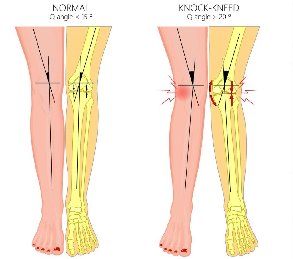 Apakah lutut ketukan? Apa itu genu valgum? Straits Podiatry