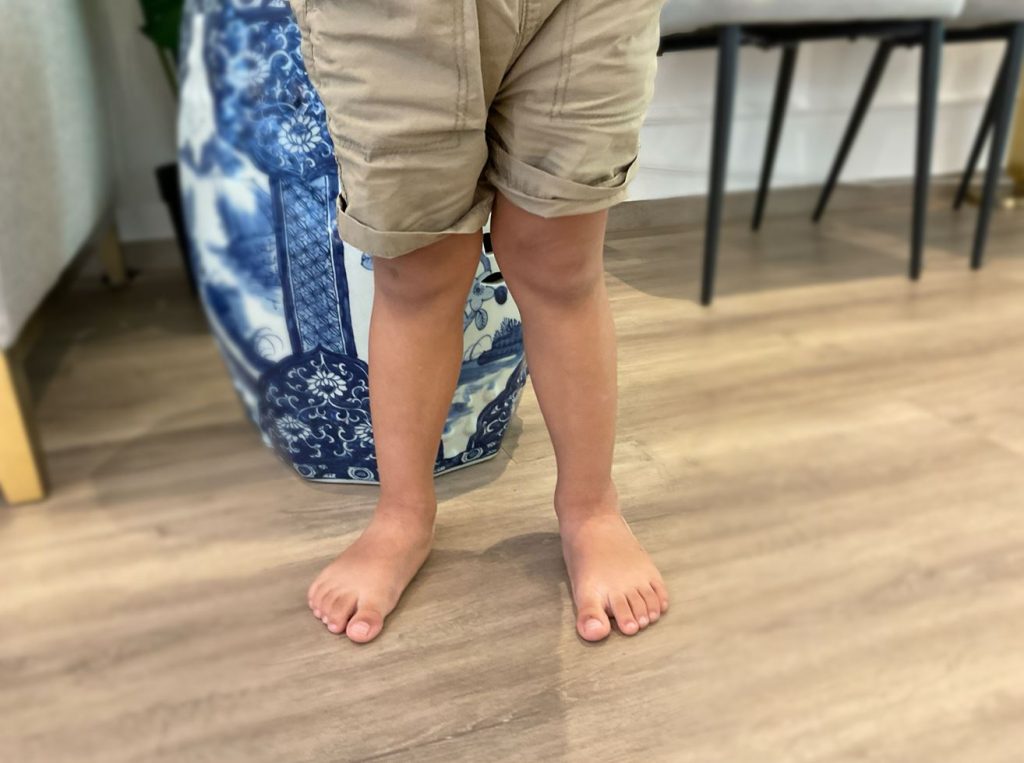 child with knock knees