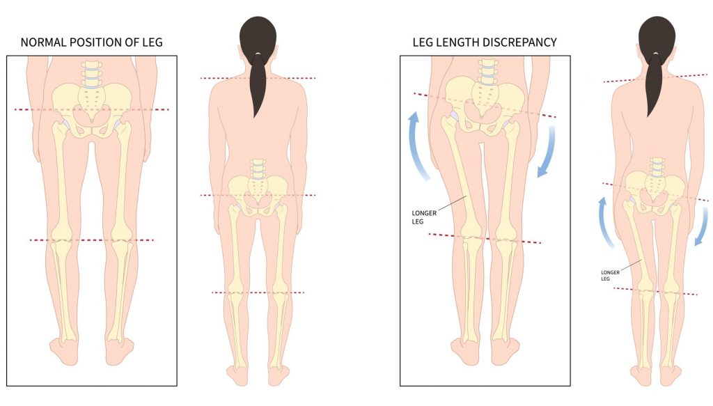 illustration of patient with leg length discrepancy