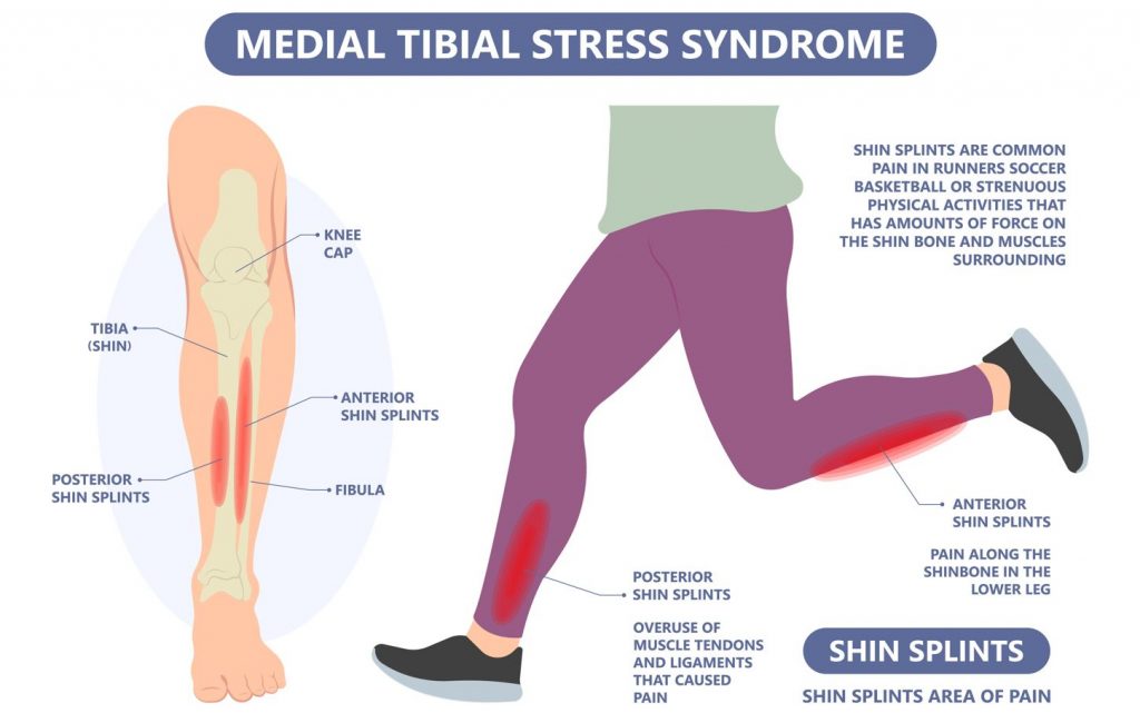 Apakah sindrom tekanan tibial medial? Apakah splint shin? Straits Podiatry