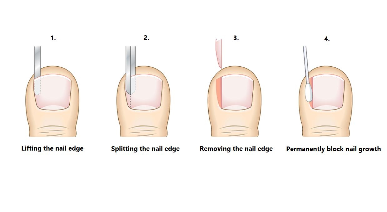 illustration on ingrown toenail surgery partial nail avulsion