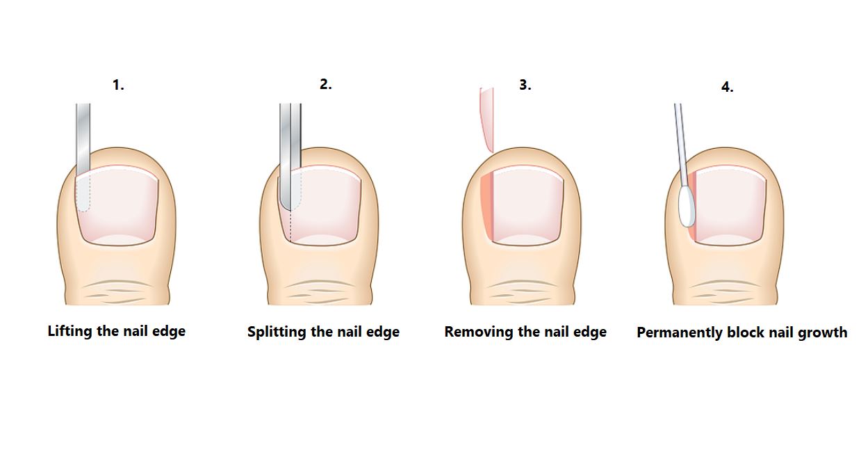 Ingrown Toenail Surgery in Singapore. Partial nail avulsion with matrixectomy.