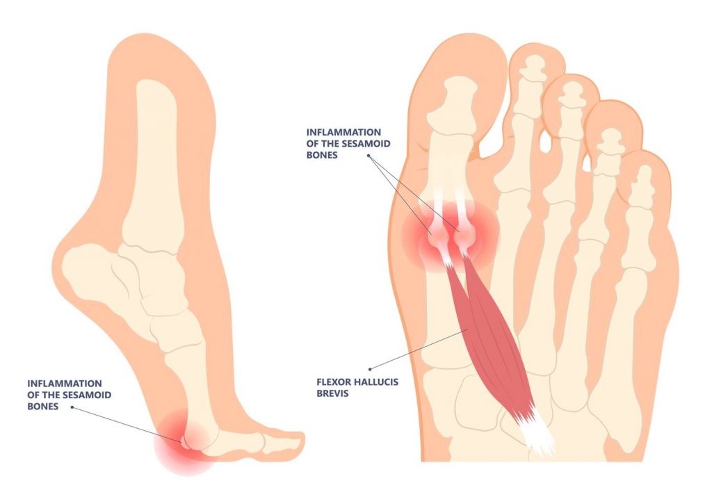 Apa itu sesamoiditis? Mengapa sendi kaki besar saya menyakitkan? Straits Podiatry Singapura