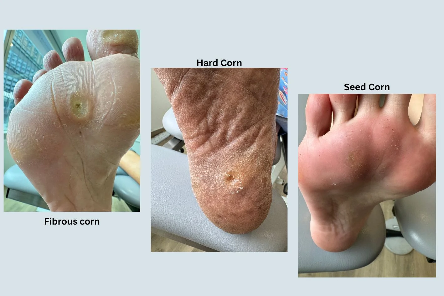 image comparing fibrous foot corn, a hard corn, and a seed corn.