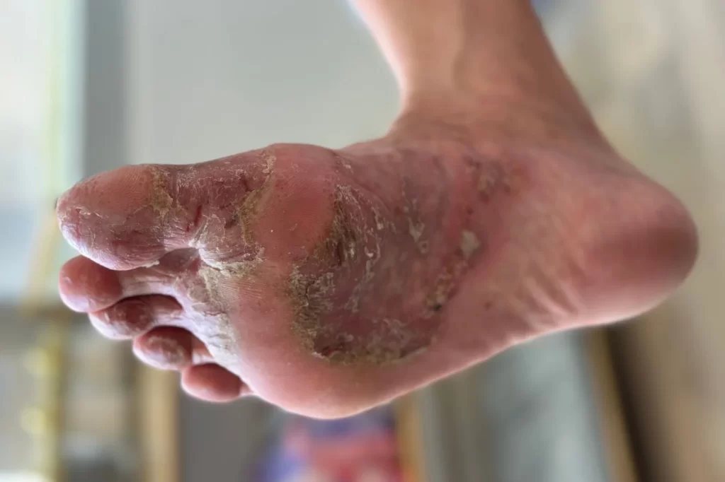 Patient with itchy and burning vesicular fungal foot infection
