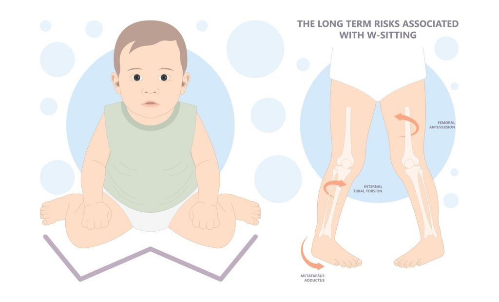 Apakah punca-punca berjalan kaki kaki? Faktor risiko kaki merpati. Straits Podiatry