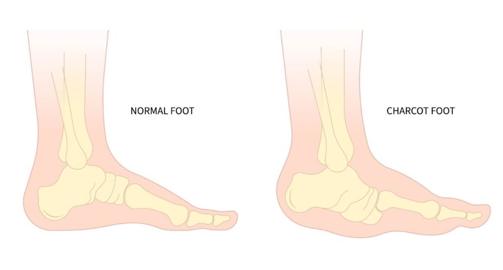 Kaki Charcot atau neuroarthropathy arang di Singapura