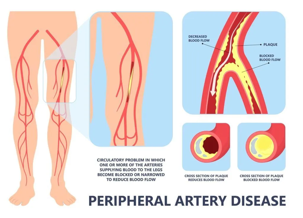 illustration on peripheral arterial disease