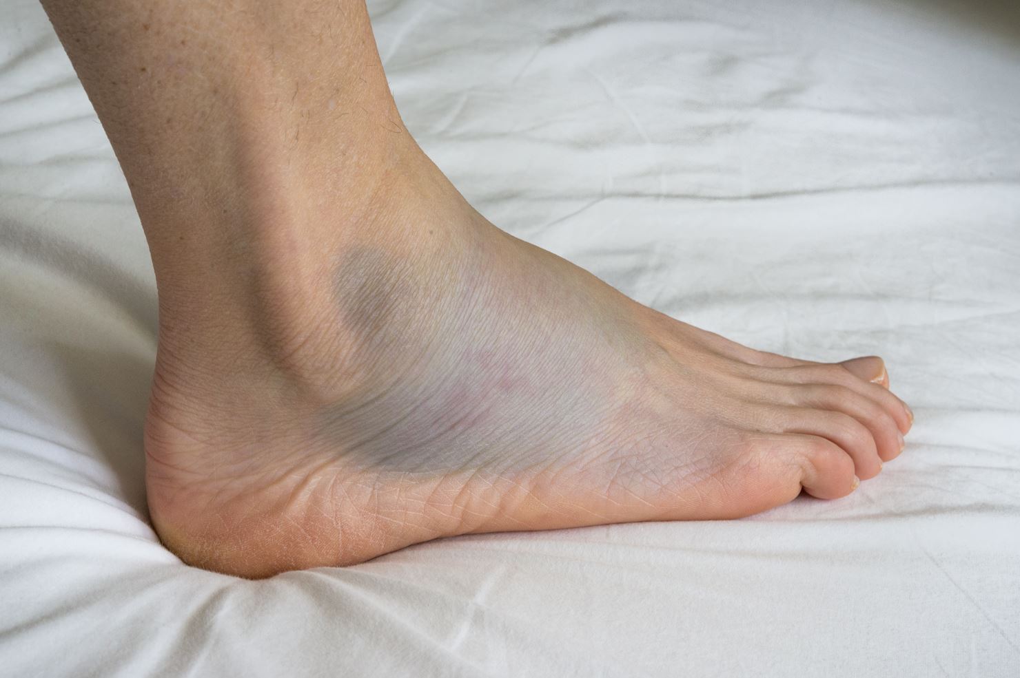 Ankle sprain is a common foot injury. Straits Podiatry Singapore