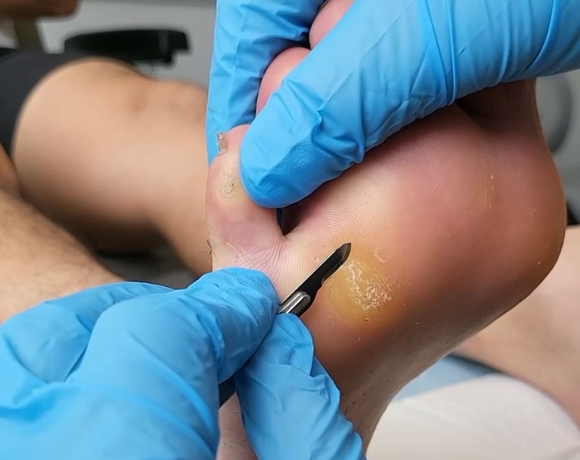 foot corn removal in Singapore