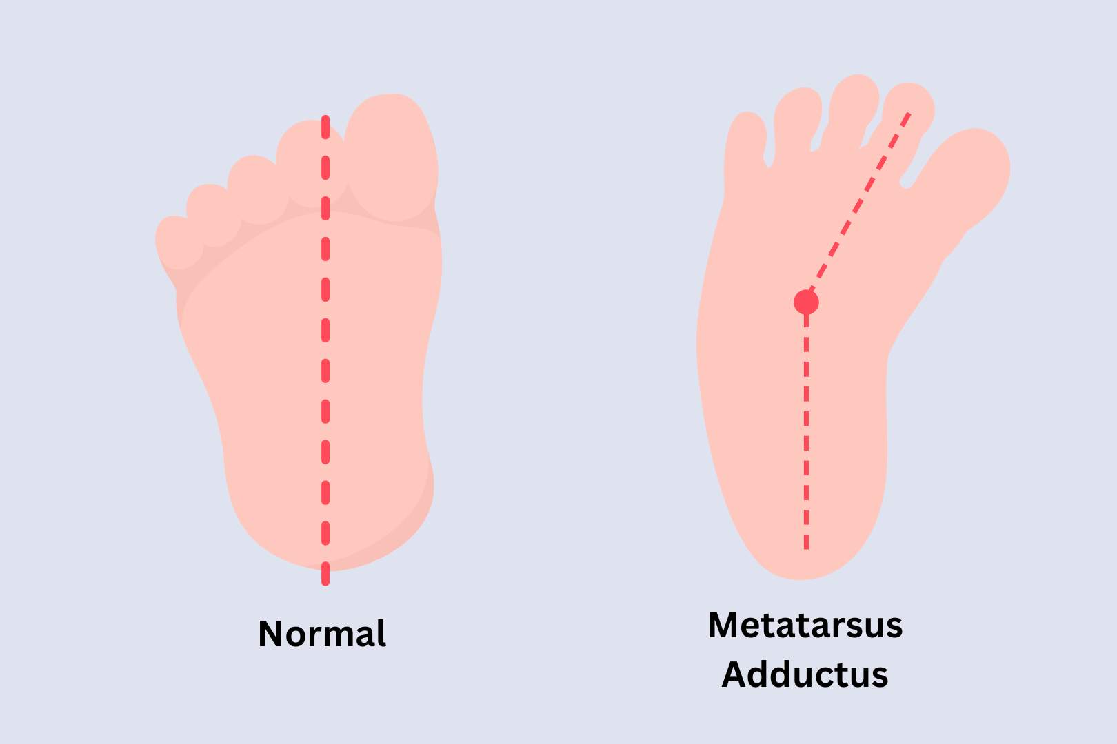 Apa itu Metatarsus Adductus? Straits Podiatry di Singapura.