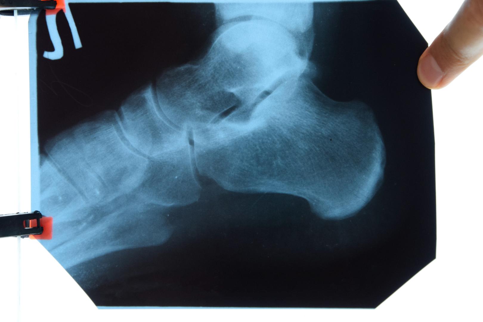足跟解剖图，新加坡海峡足科医院。一张显示足跟解剖结构的X光照片。