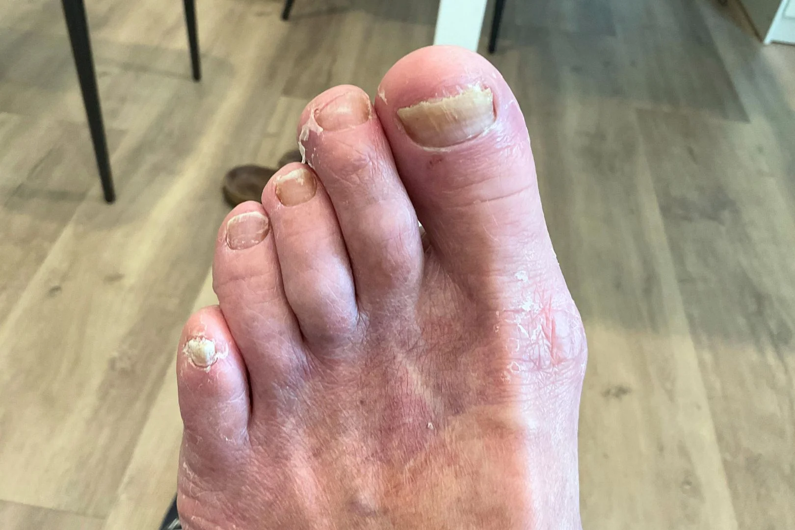 Fungal nail clinic in Singapore