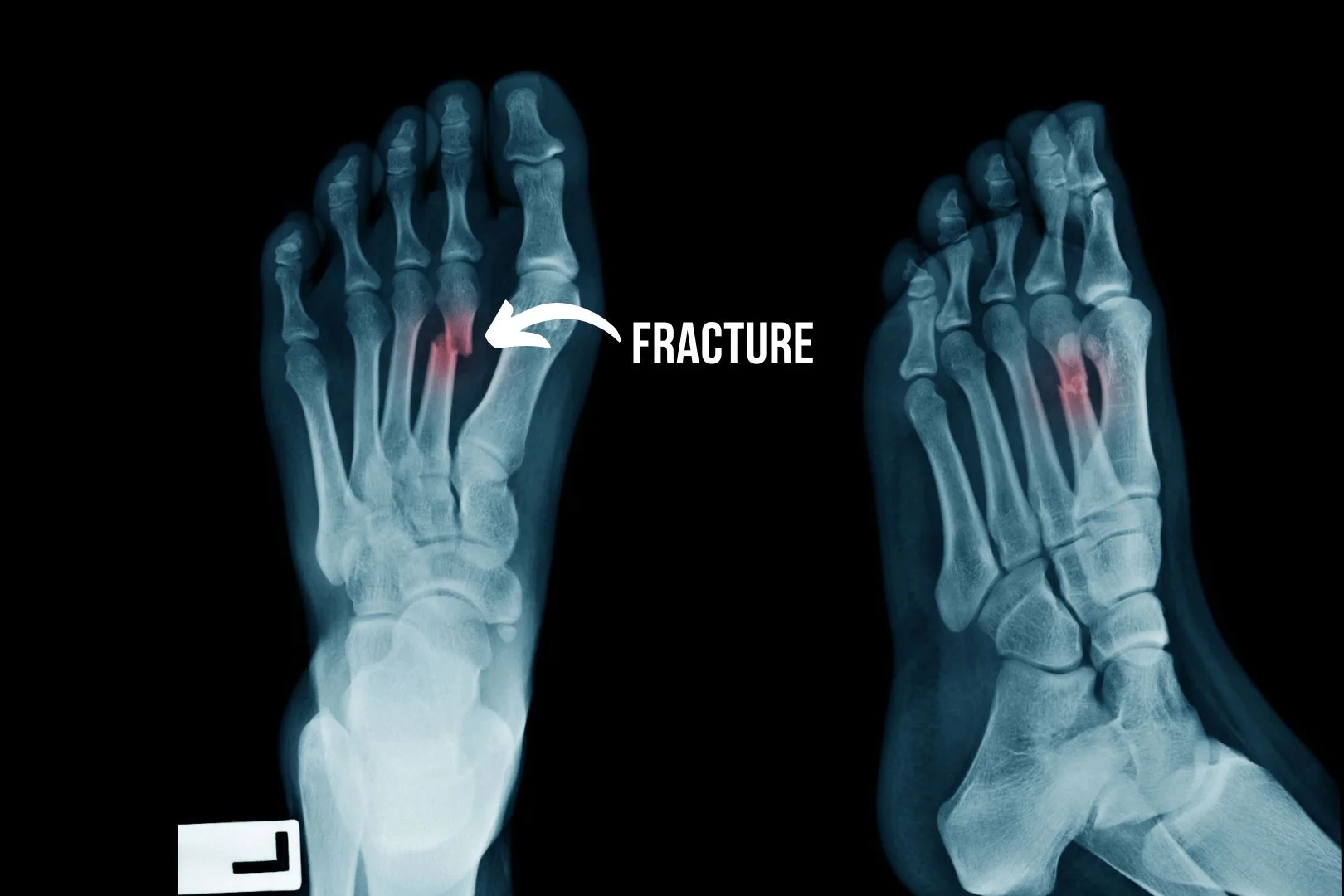 Foot fracture