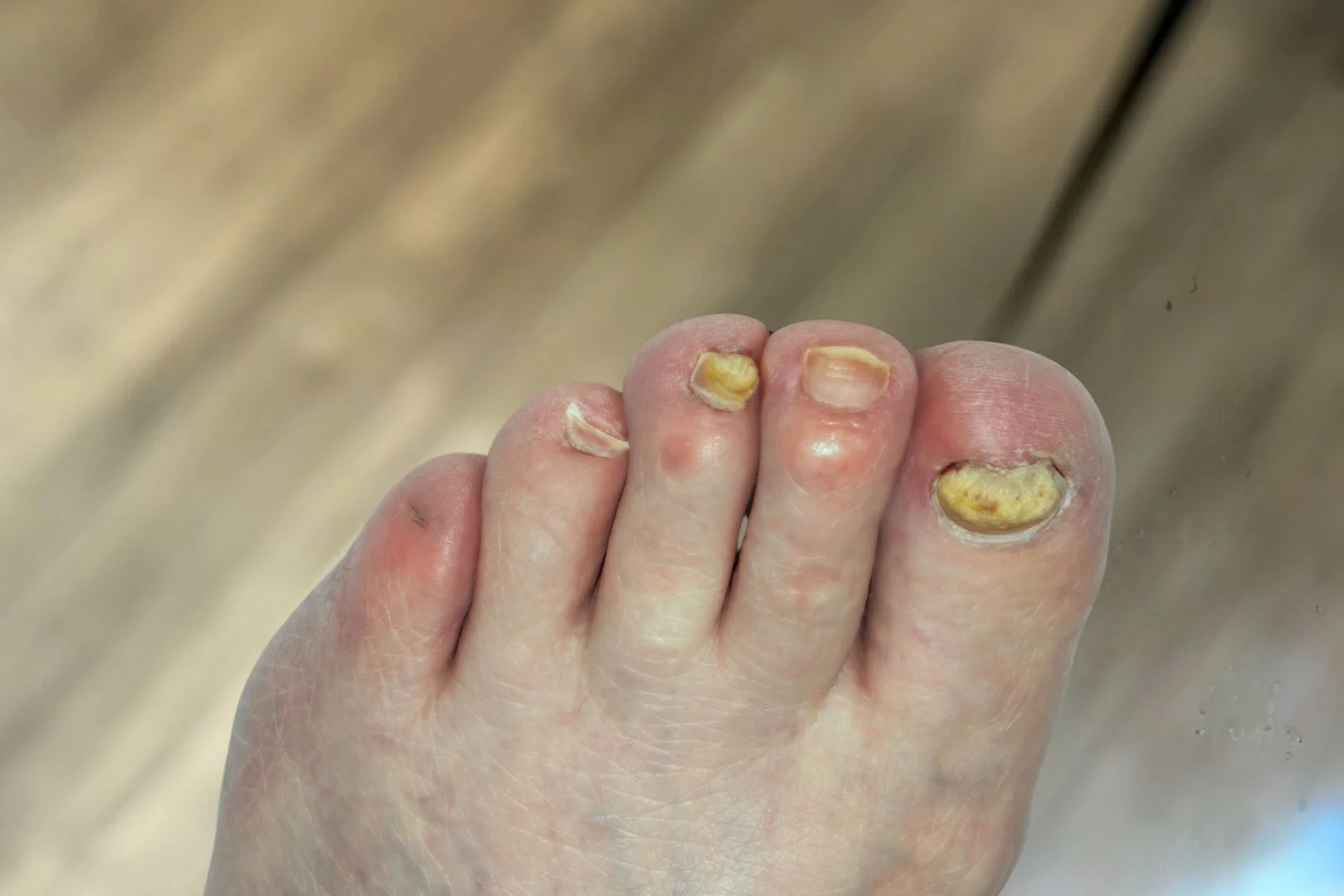 Severe Fungal Toenails