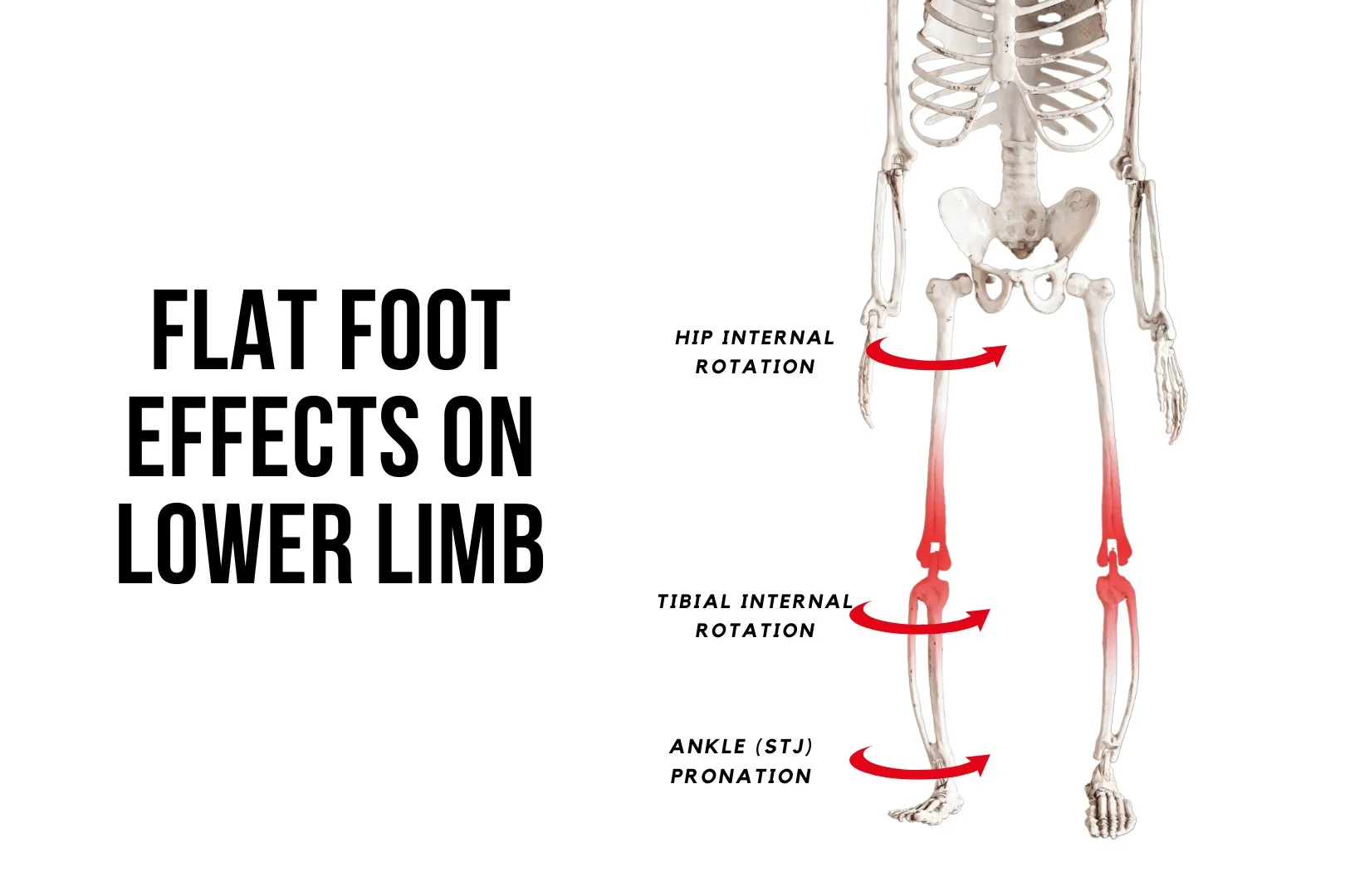 Custom insoles for flat feet