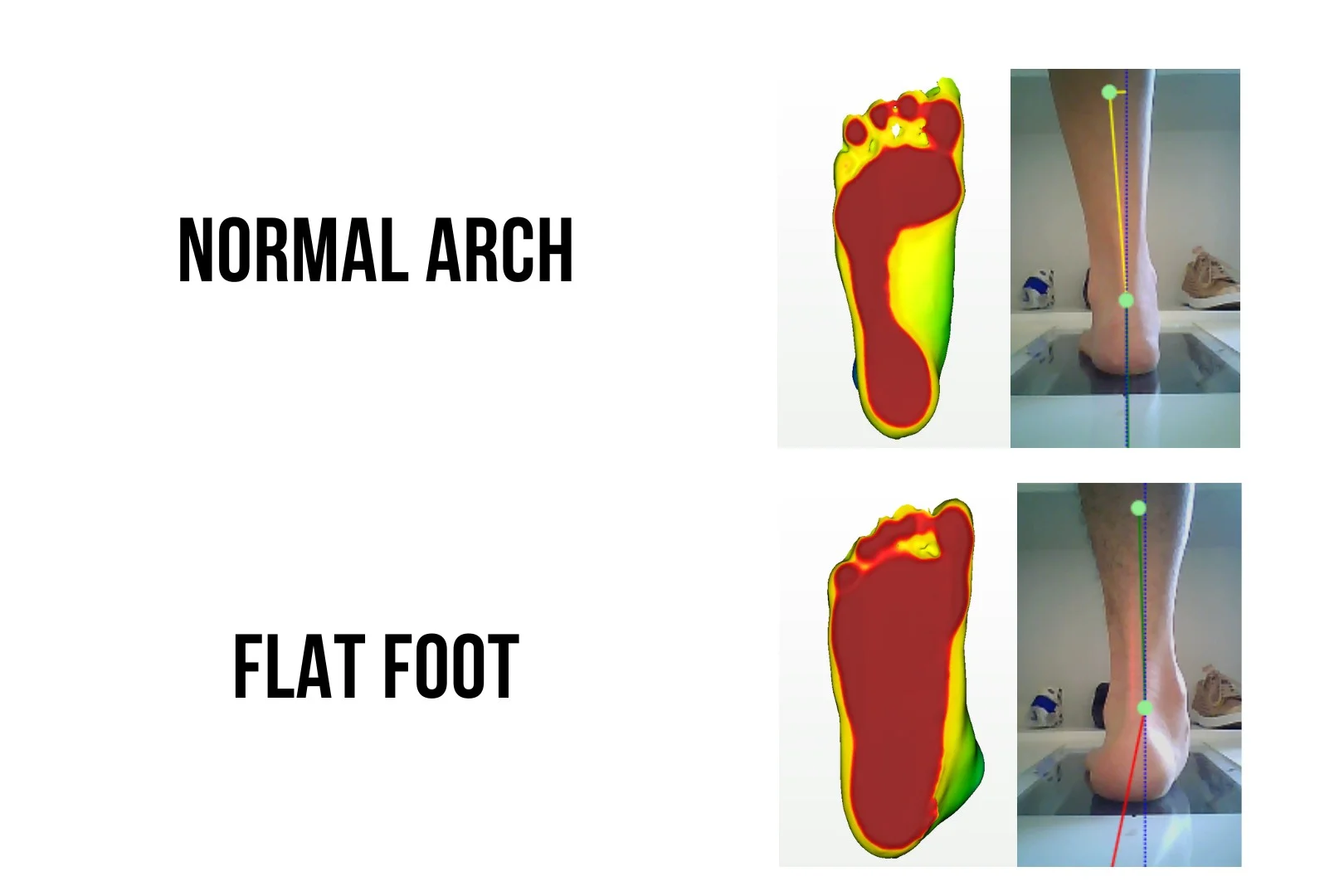 Flat foot insoles
