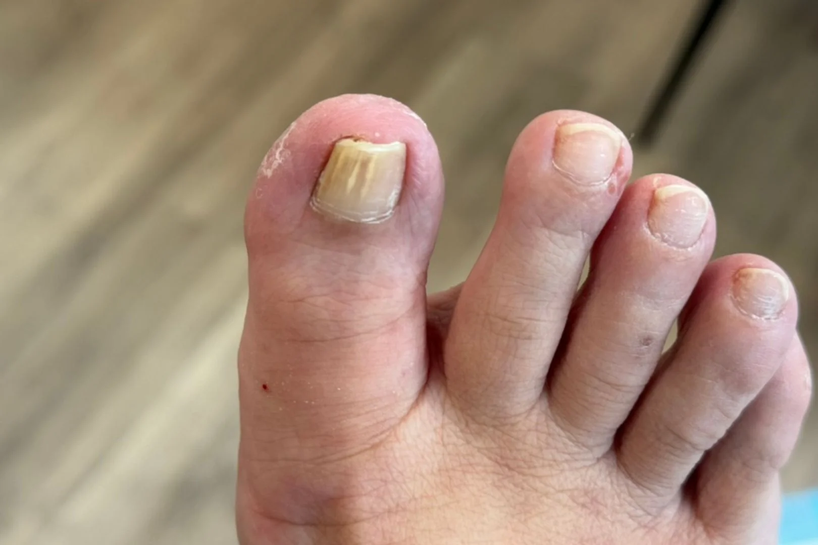 Nail fungus causing ingrown toenail