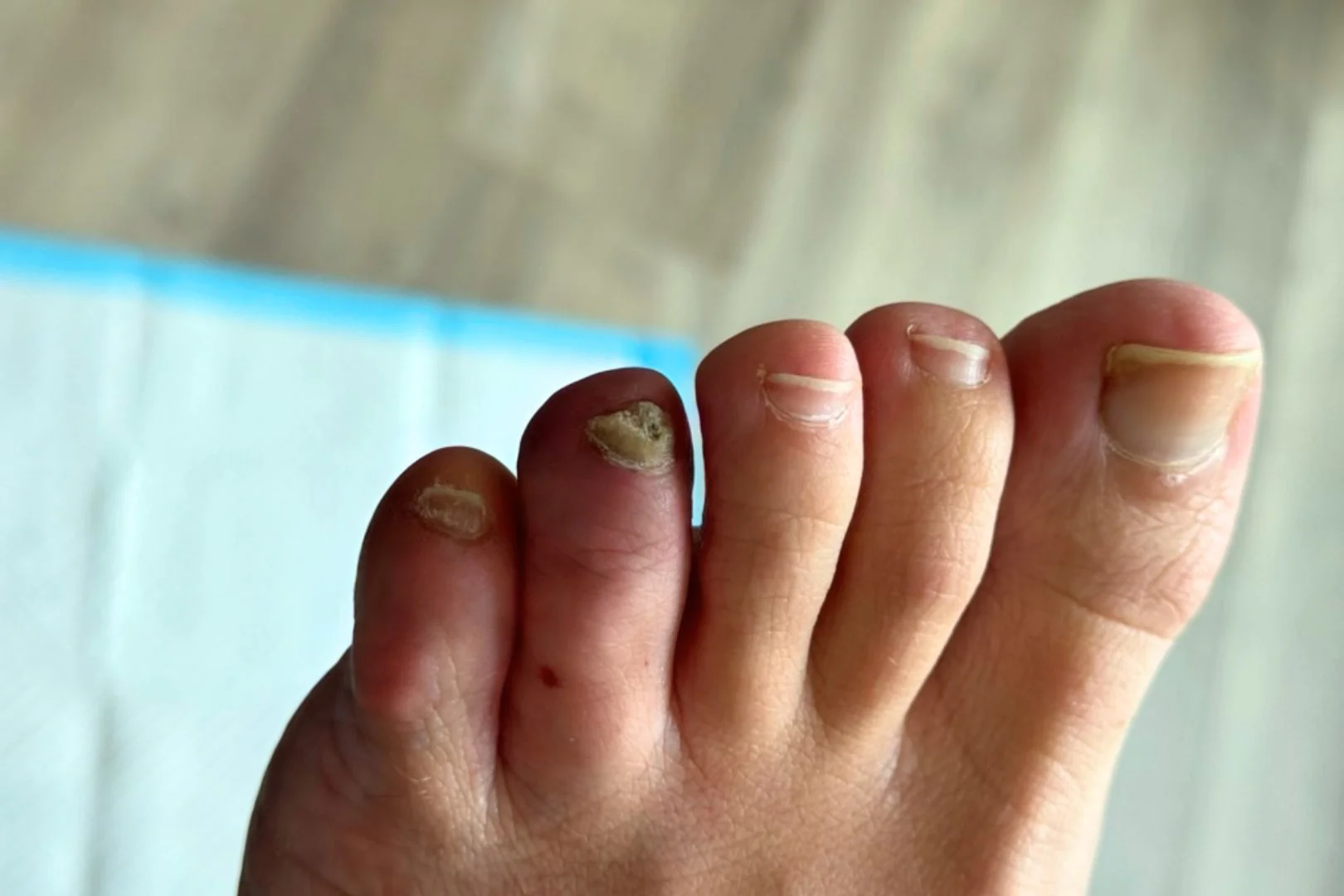 Severe fungal nail infection