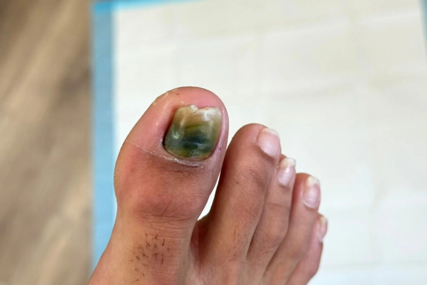 Green nail syndrome