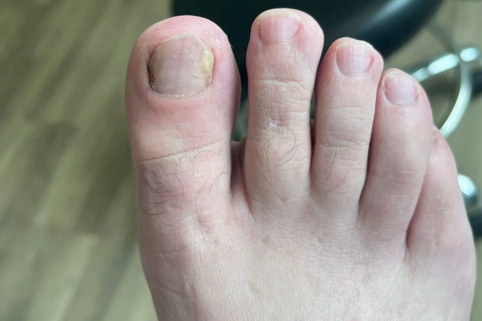 Mild nail fungus of the big toe