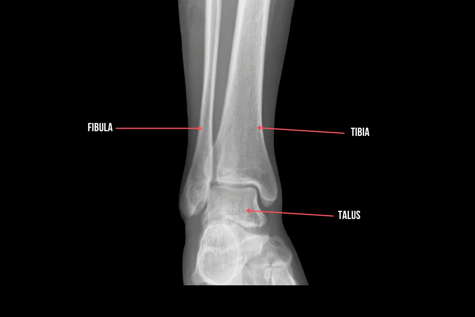 X-ray showing the anatomy of the ankle
