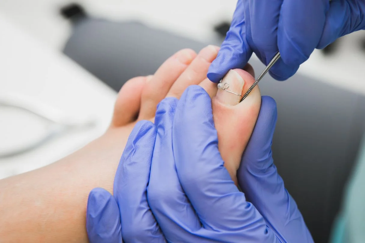 Nail Bracing for ingrown toenail