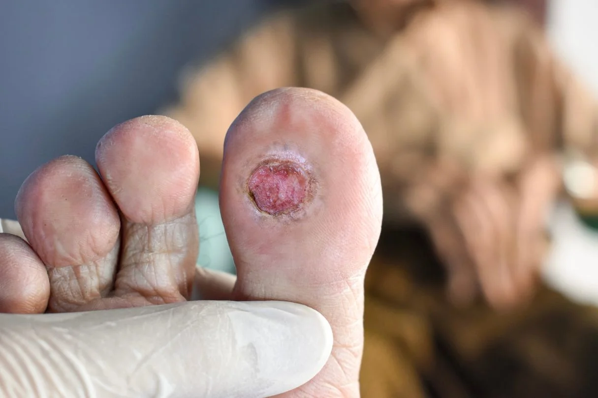 Diabetic foot ulcer under the right big toe