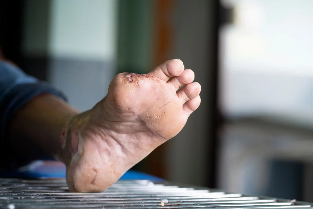 amputasi ibu jari kaki berkaitan diabetes