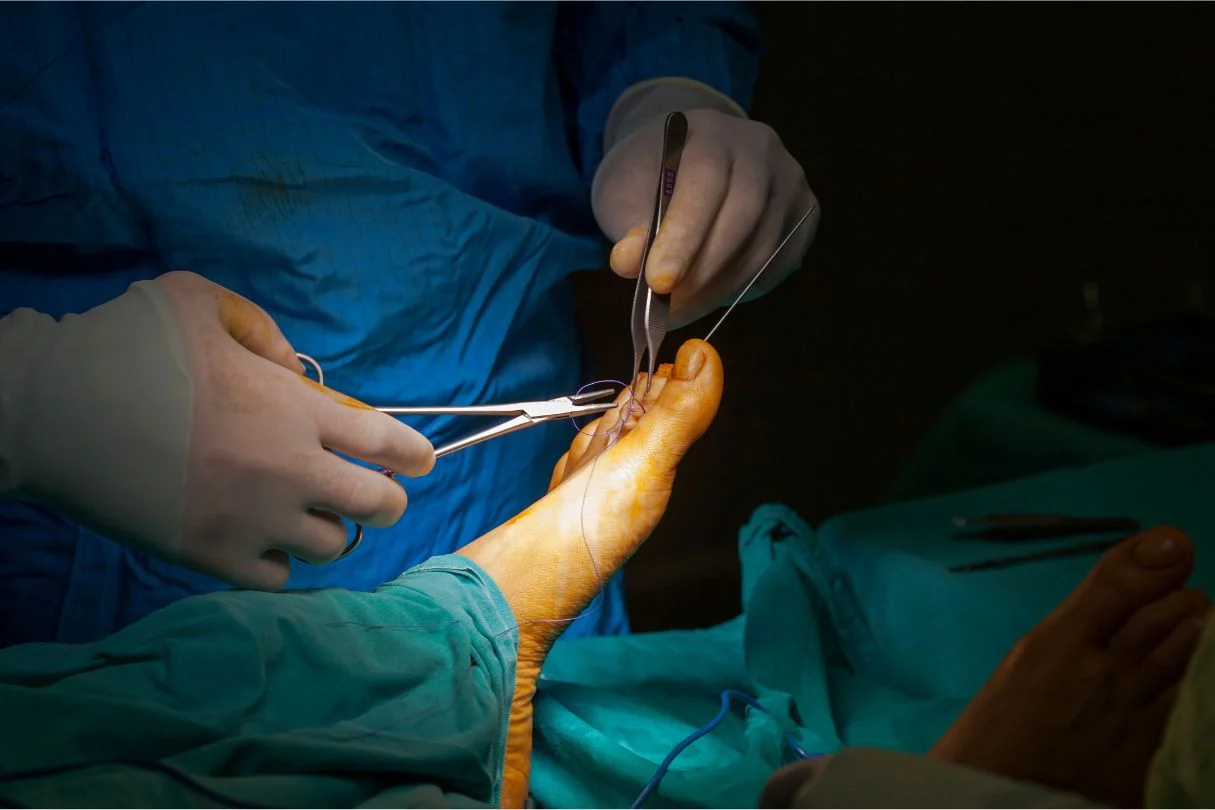 Pembedahan neuroma Morton