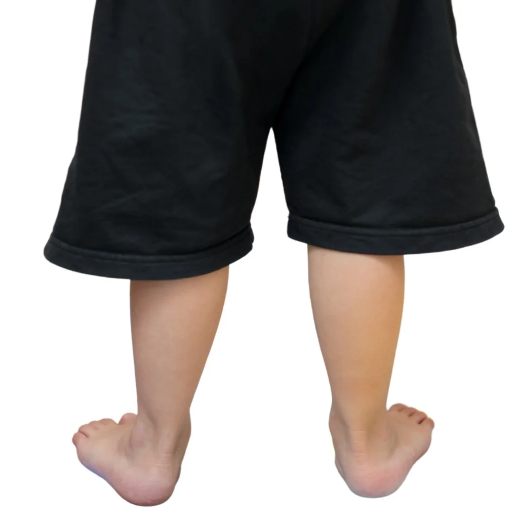 Children flat feet seen by Podiatrist of Straits Podiatry in Singapore