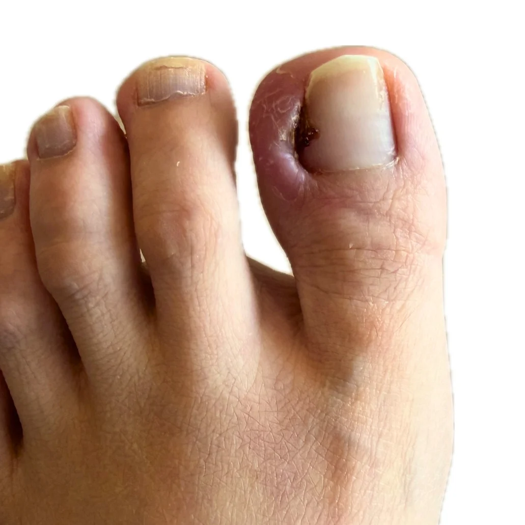 ingrown toenail with infection