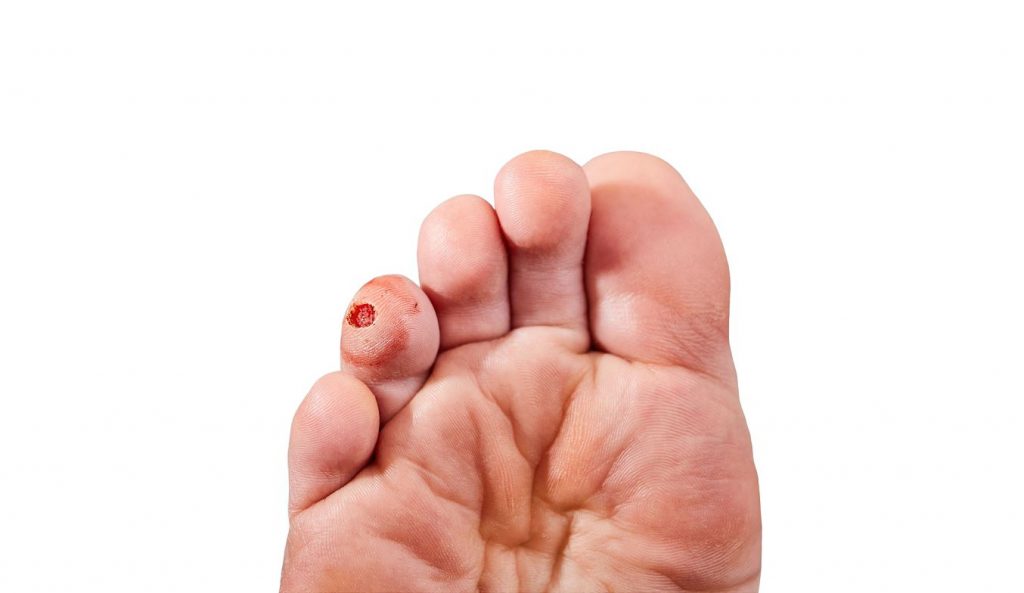 wart needling and Curettage on patient foot