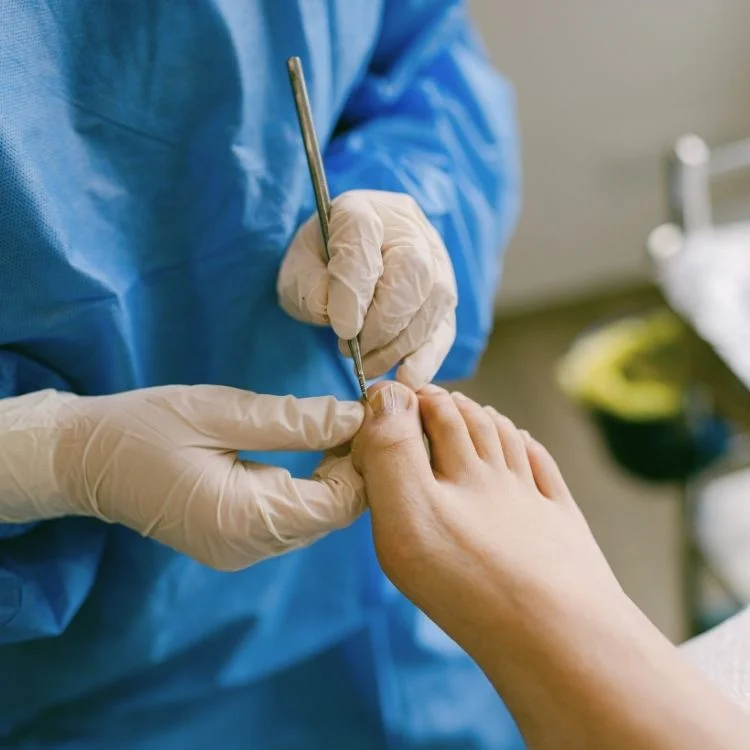 Podiatrist performing partial nail avulsion, a ingrown toenail surgery procedure