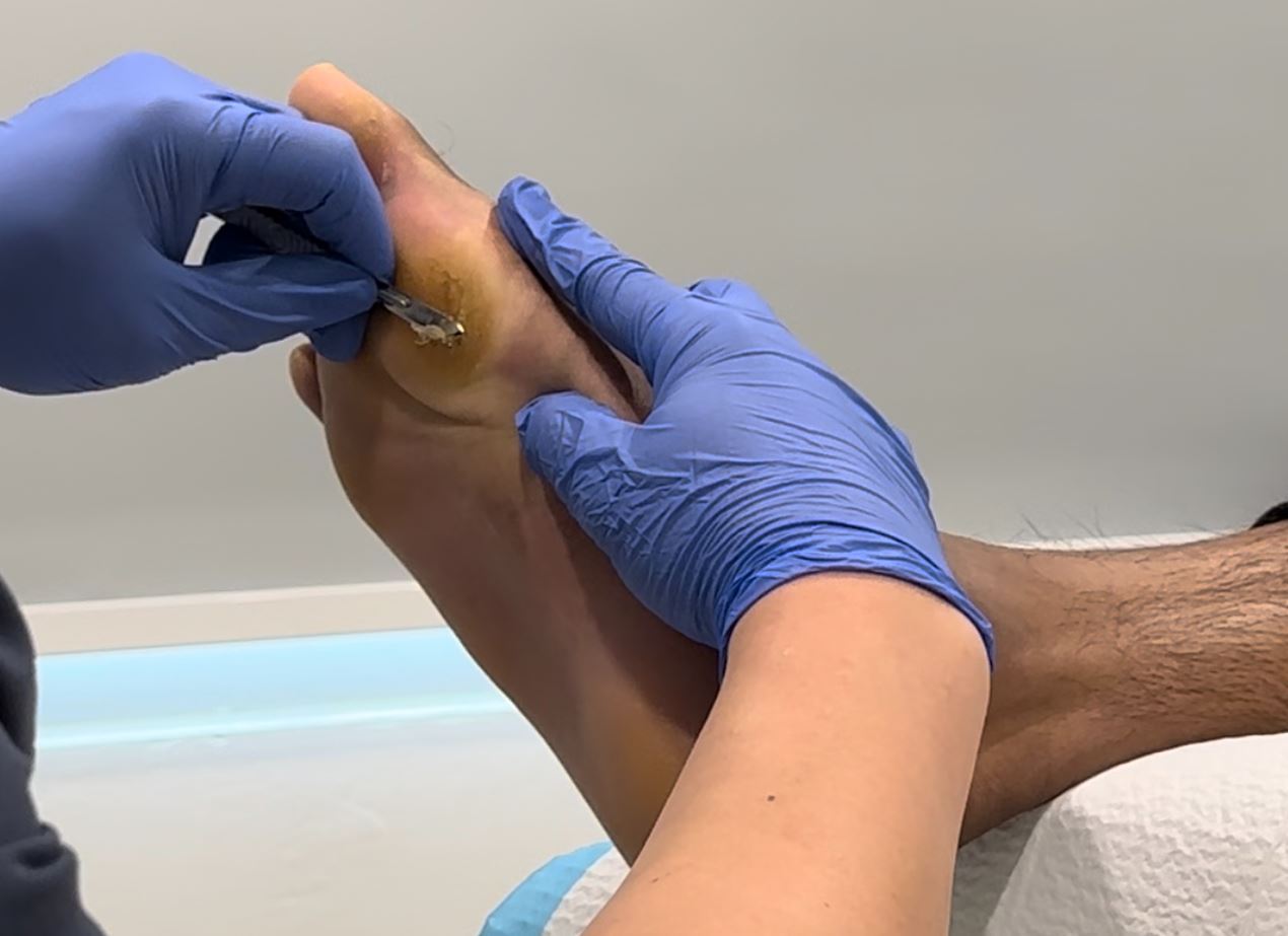 podiatrist removing calluses in Singapore