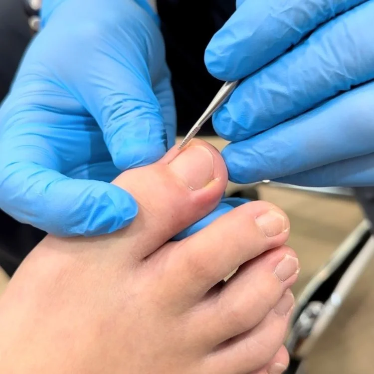 Podiatrist removing ingrown toenails conservatively through nail trimming.