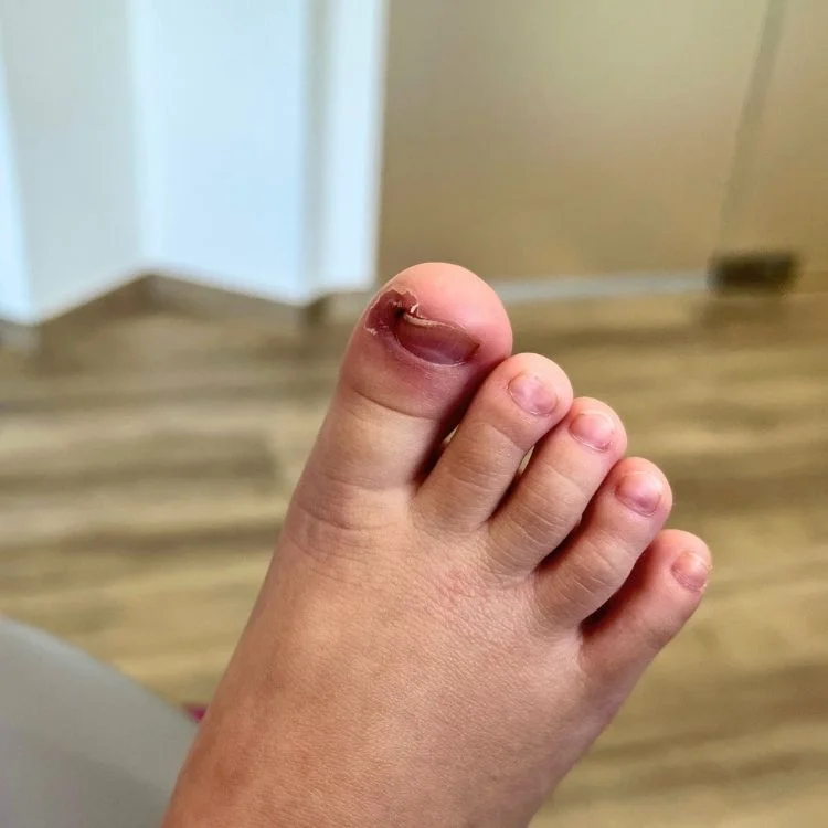 ingrown toenail in children