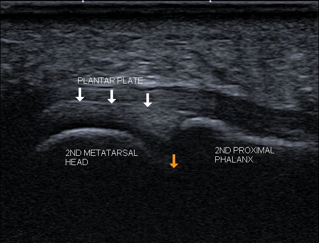 diagnostic ultrasound image of the plantar plate