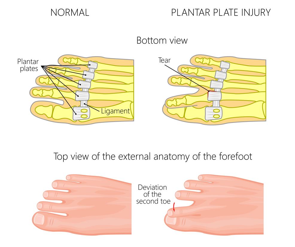 Illustration explaining plantar plate tear