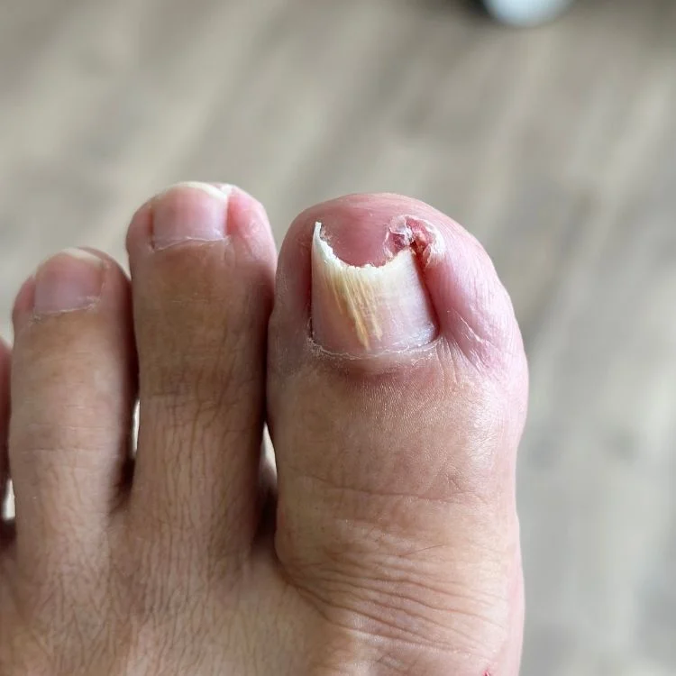 recurring ingrown toenail due to fungal infection