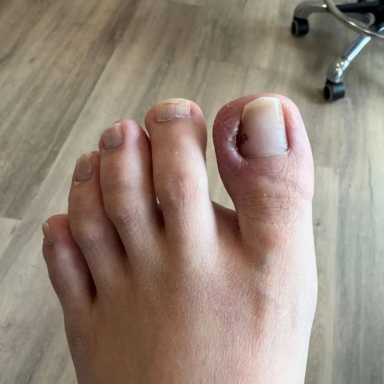 red, painful, and swollen ingrown toenail
