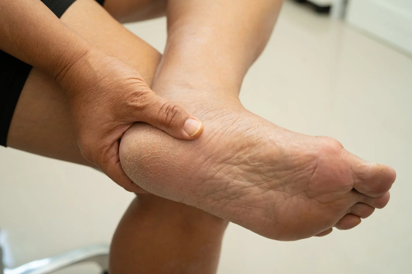 Elderly with heel pain of the left foot