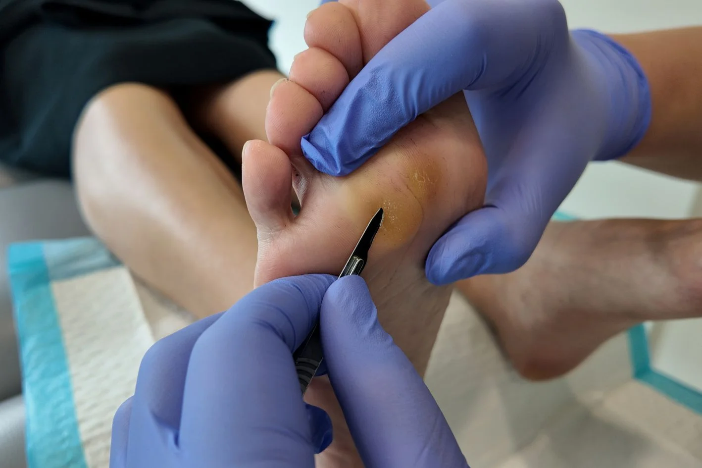 Callus removal by podiatrist at Straits Podiatry