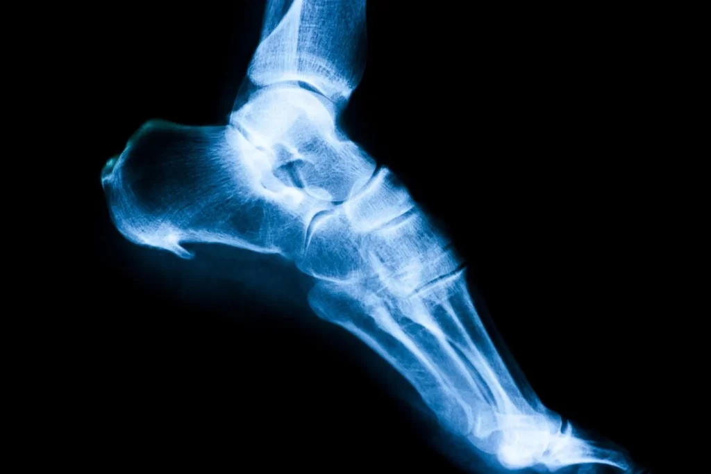x-ray image showing a heel spur under the foot