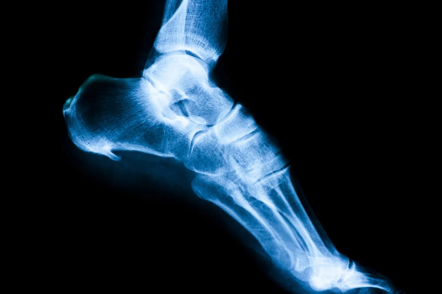 x-ray image showing a heel spur under the foot
