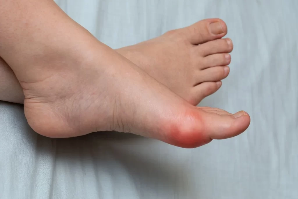 Painful and swollen big toe due to either gout or bunion