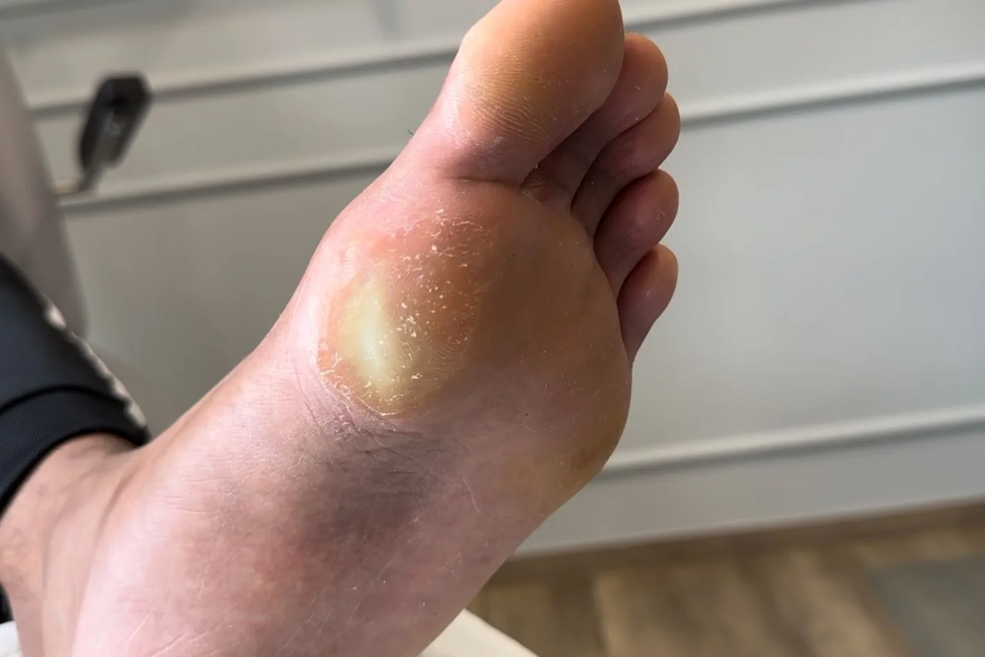 painful chronic fibrous callus under left foot