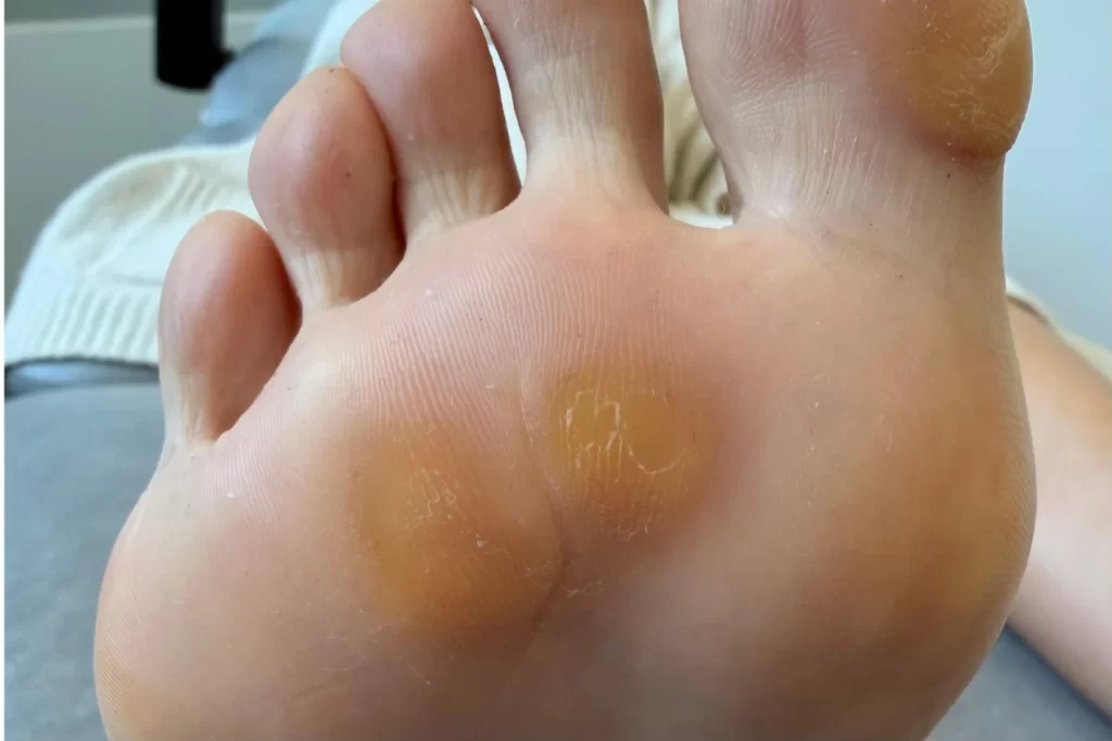 painful foot calluses under the right foot