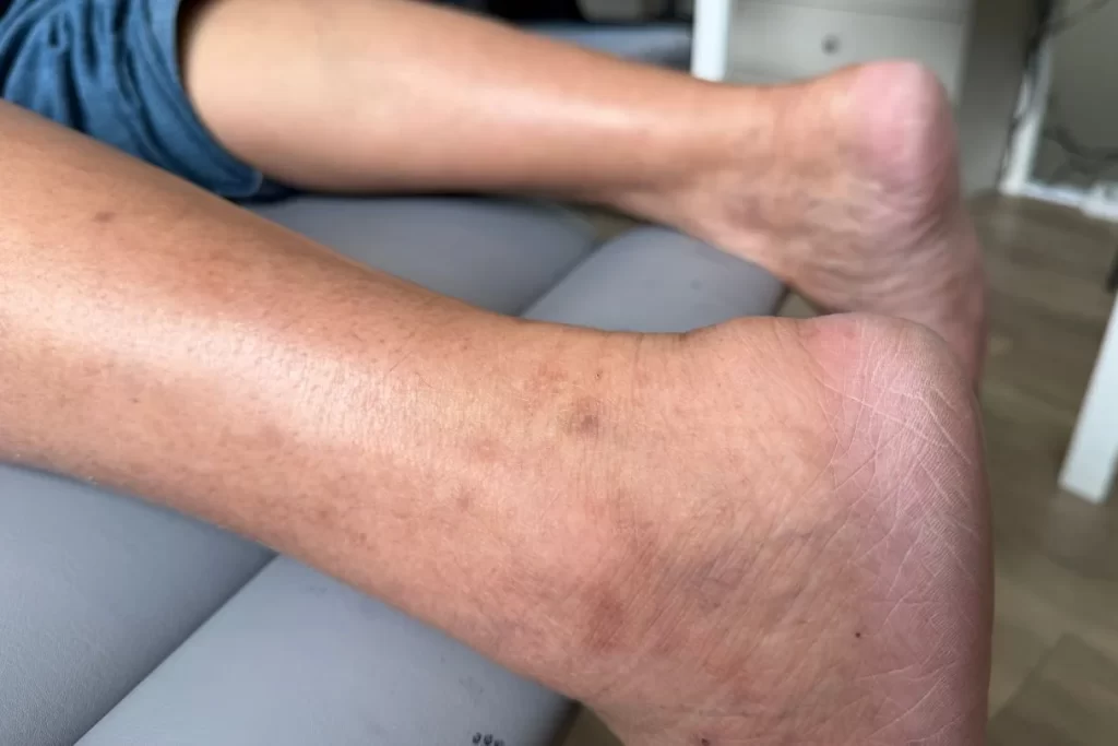 Person suffering from back of heel pain caused by insertional achilles tendinitis